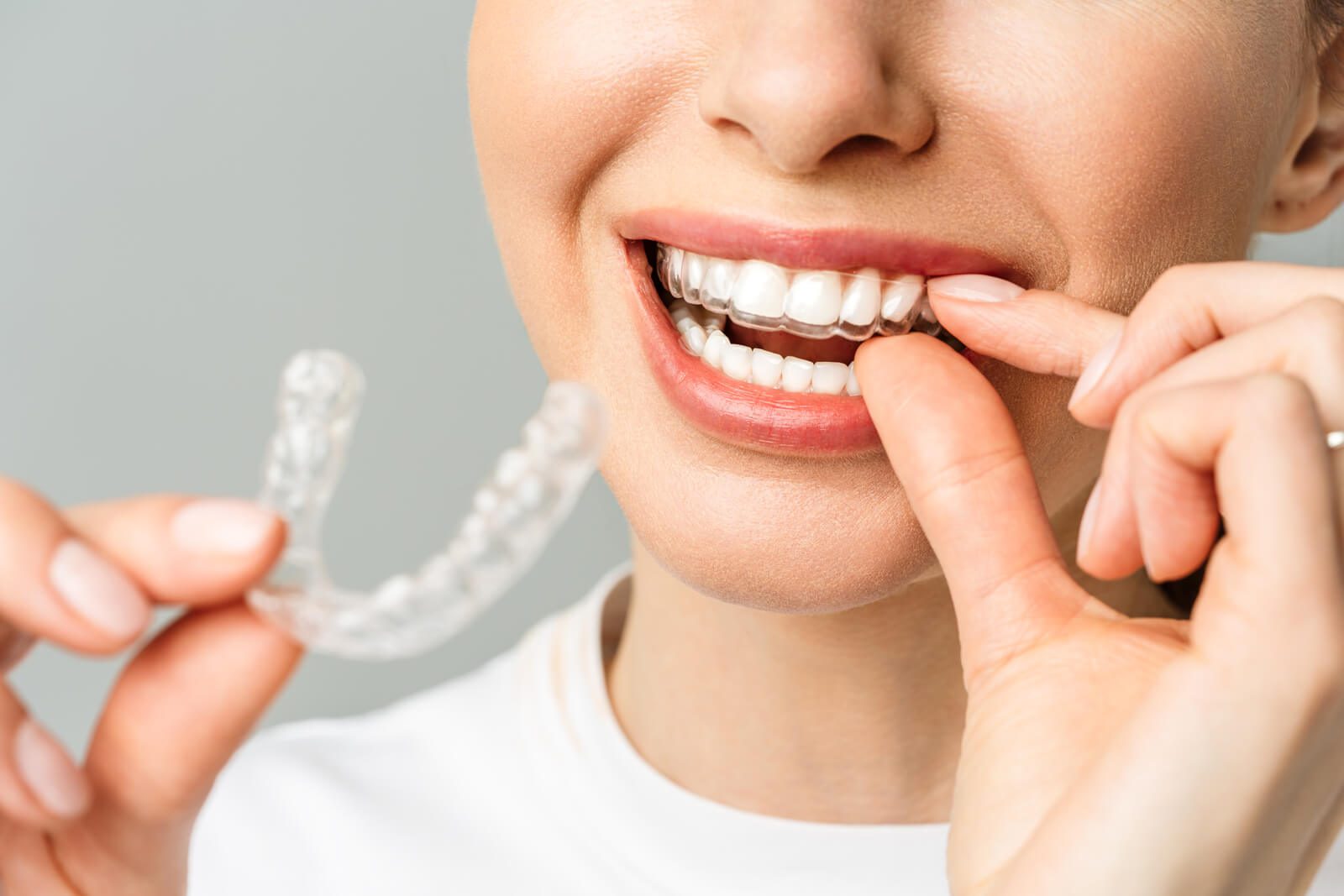Denta One Aligner - ISAR Dental - Unsichtbare Zahnschiene